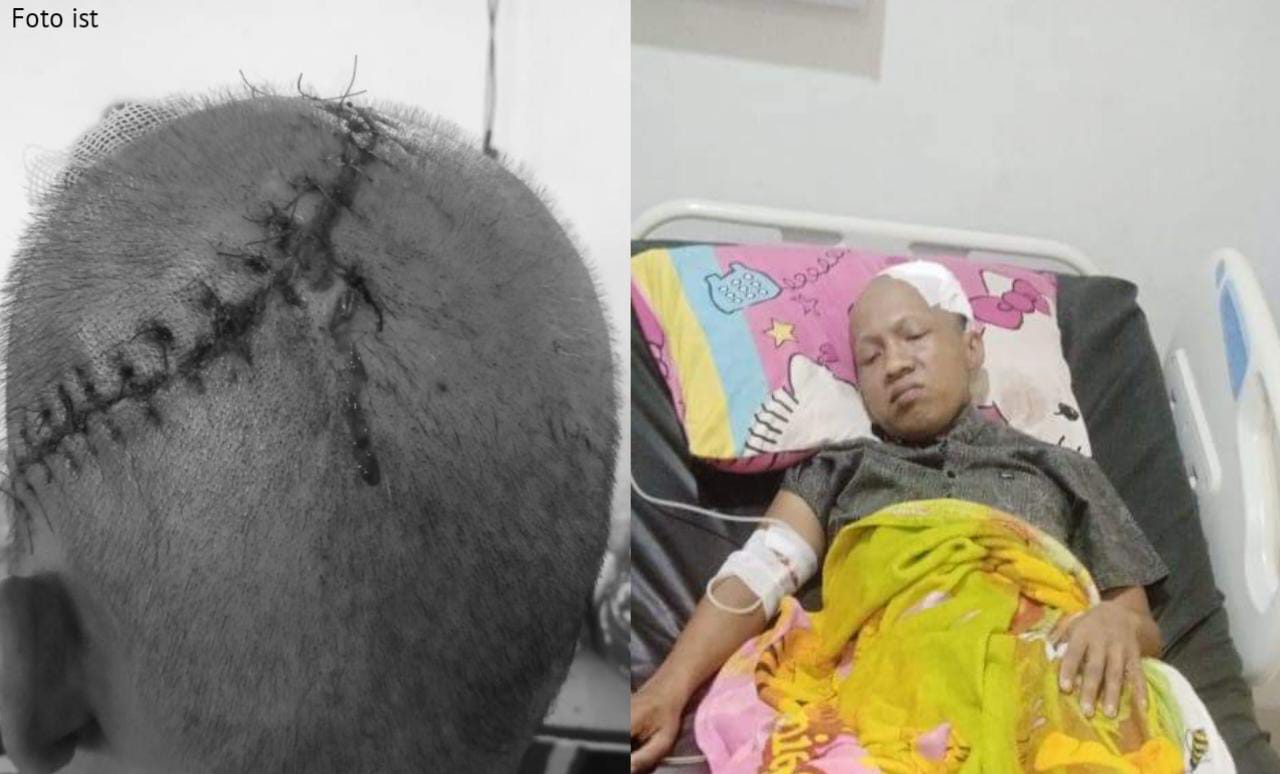 Berjuang Melawan Tumor Otak, Reki Menanti Uluran Tangan Para Dermawan