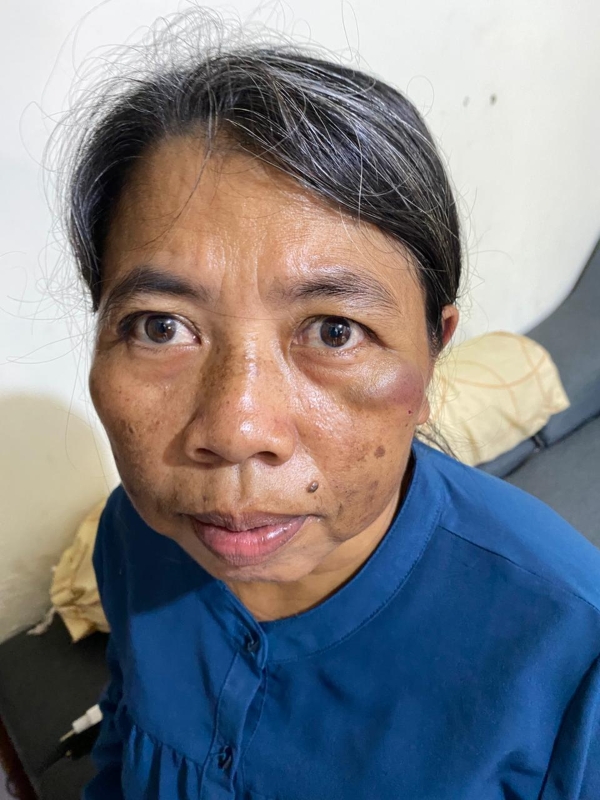 Diduga Aniaya ART Sejak 2017, Oknum Dokter PNS di Bandarlampung Dilaporkan ke Polisi